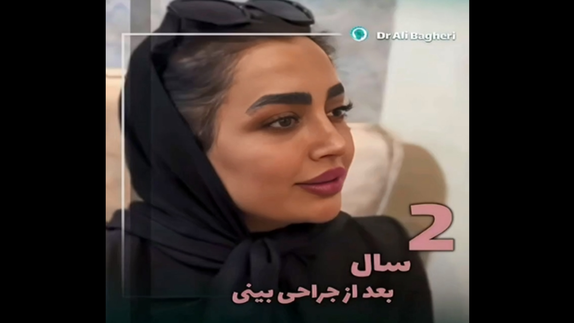 نتیجه عمل بینی بعد از 2 سال با قوس ملایم و متناسب صورت _ دکتر باقری حق دکتر علی باقری حق