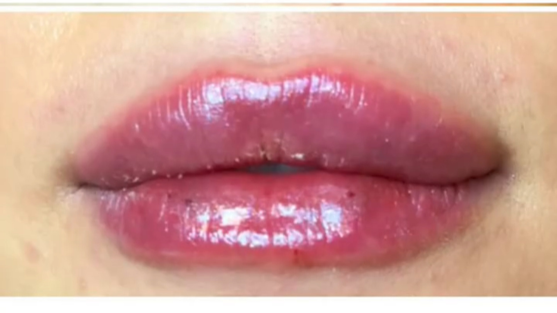 نمونه کار فیلر لب نچرال و طبیعی دکتر مریم فرخشاهی - پوست، مو و زیبایی