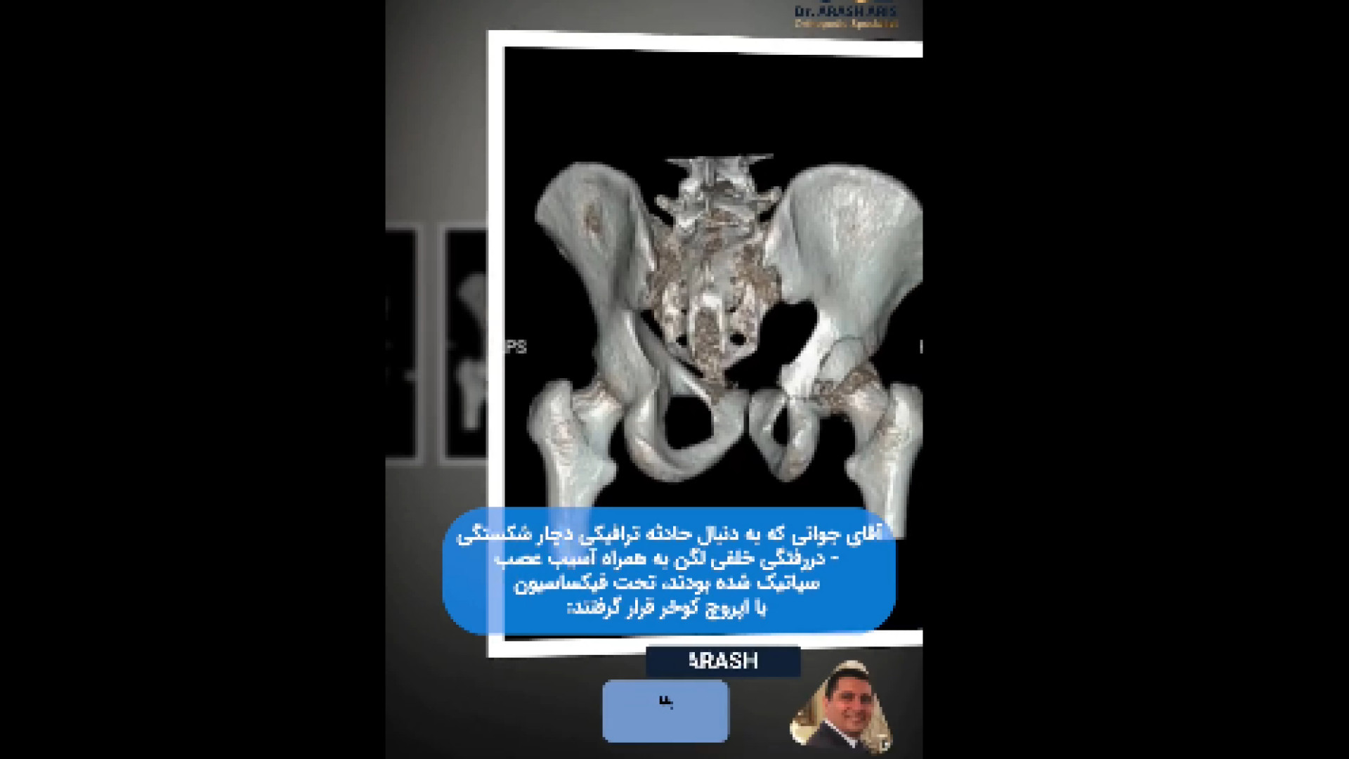 دررفتگی خلفی لگن دکتر آرش اریس