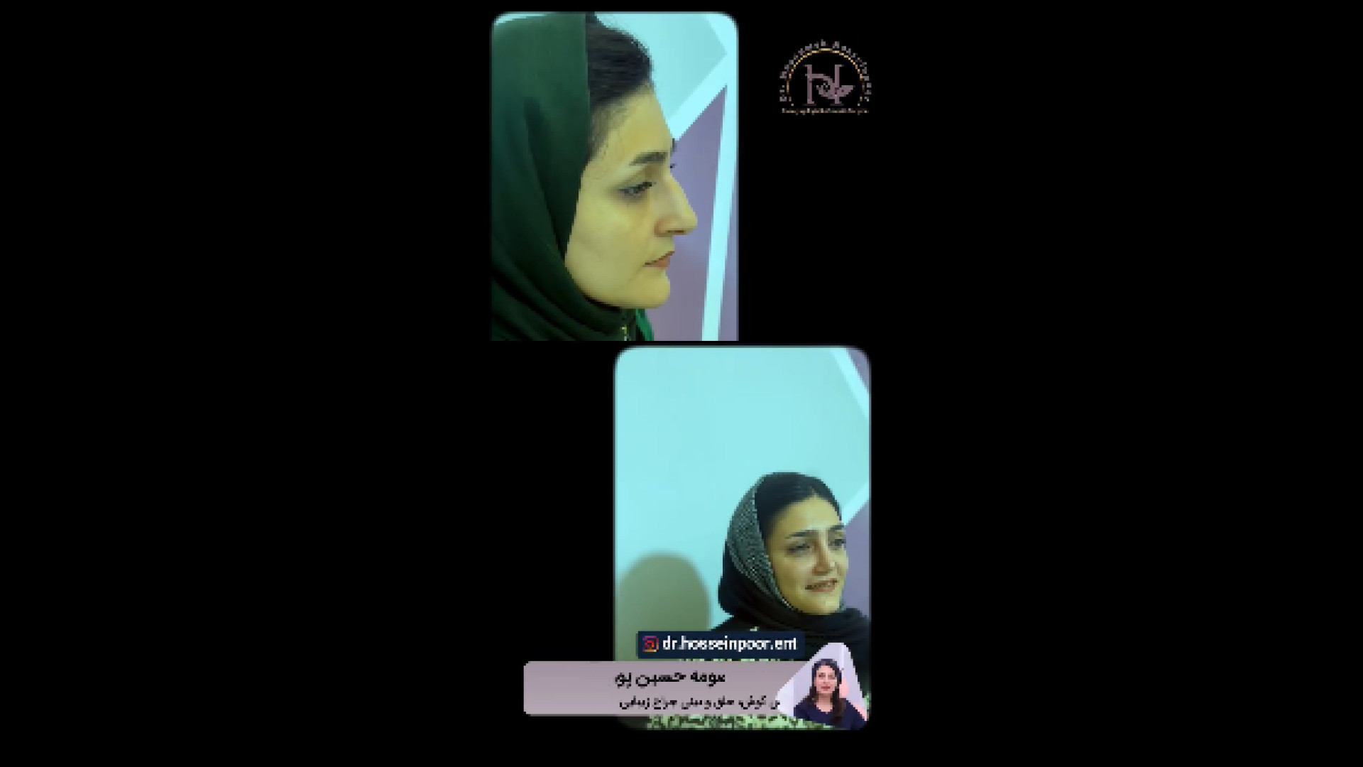 نتیجه جذاب عمل بینی دکتر معصومه حسین پور