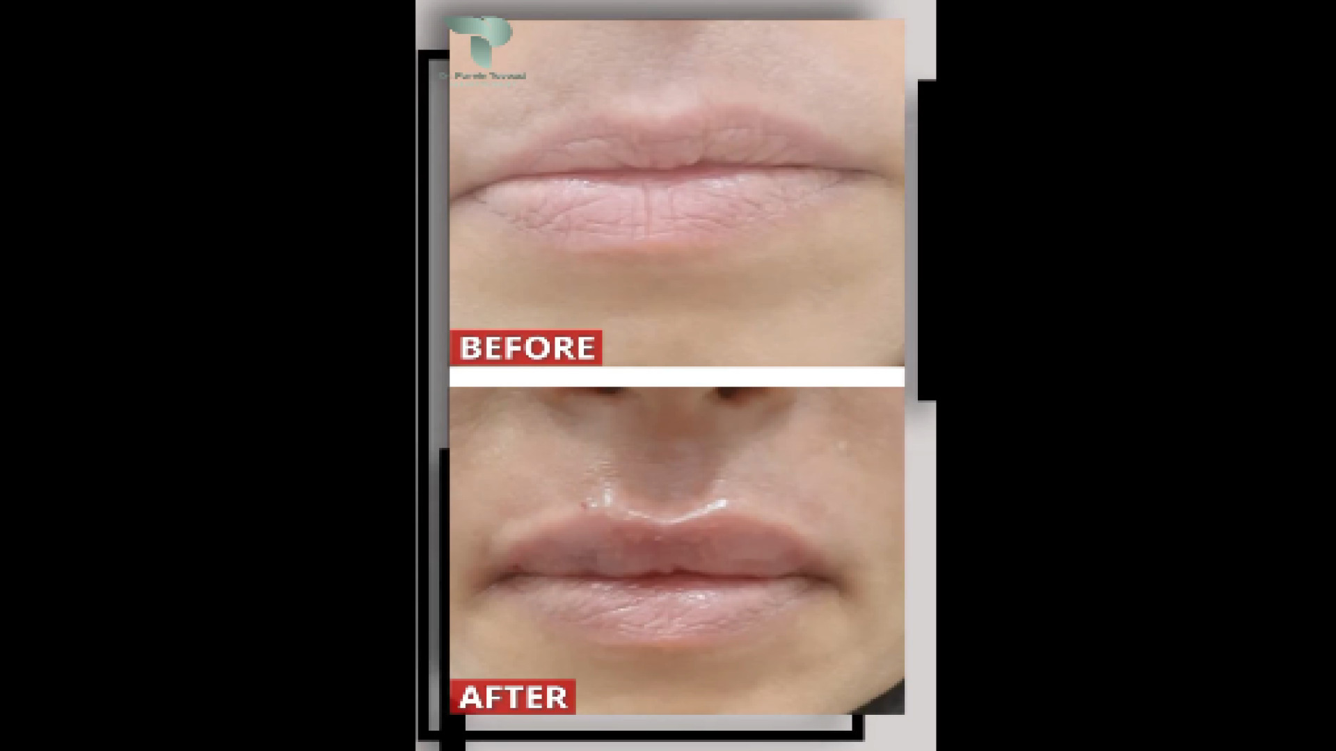 نمونه کار فیلر لب دکتر پروین طاوسی - متخصص پوست، مو و زیبایی