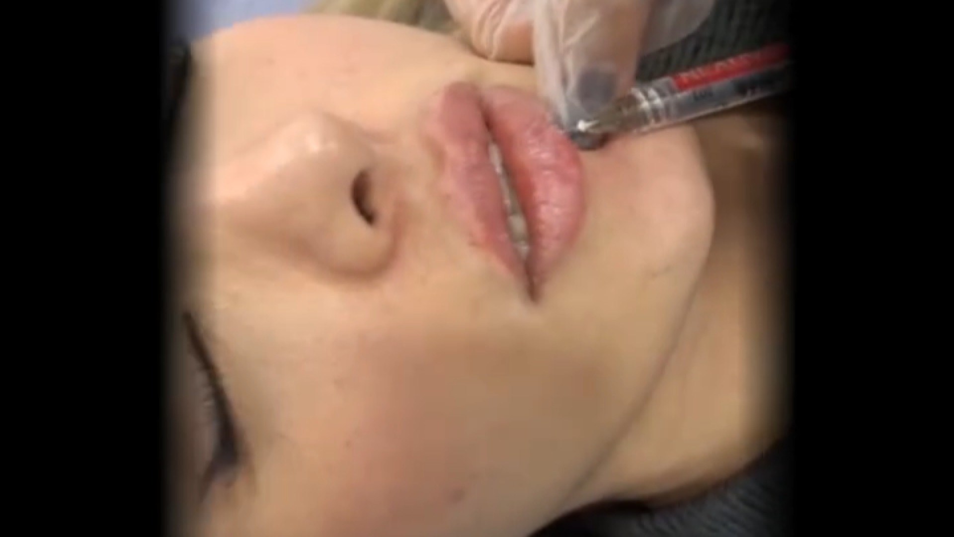 تزریق فیلر لب دکتر بهناز همدانی - متخصص پوست، مو و زیبایی