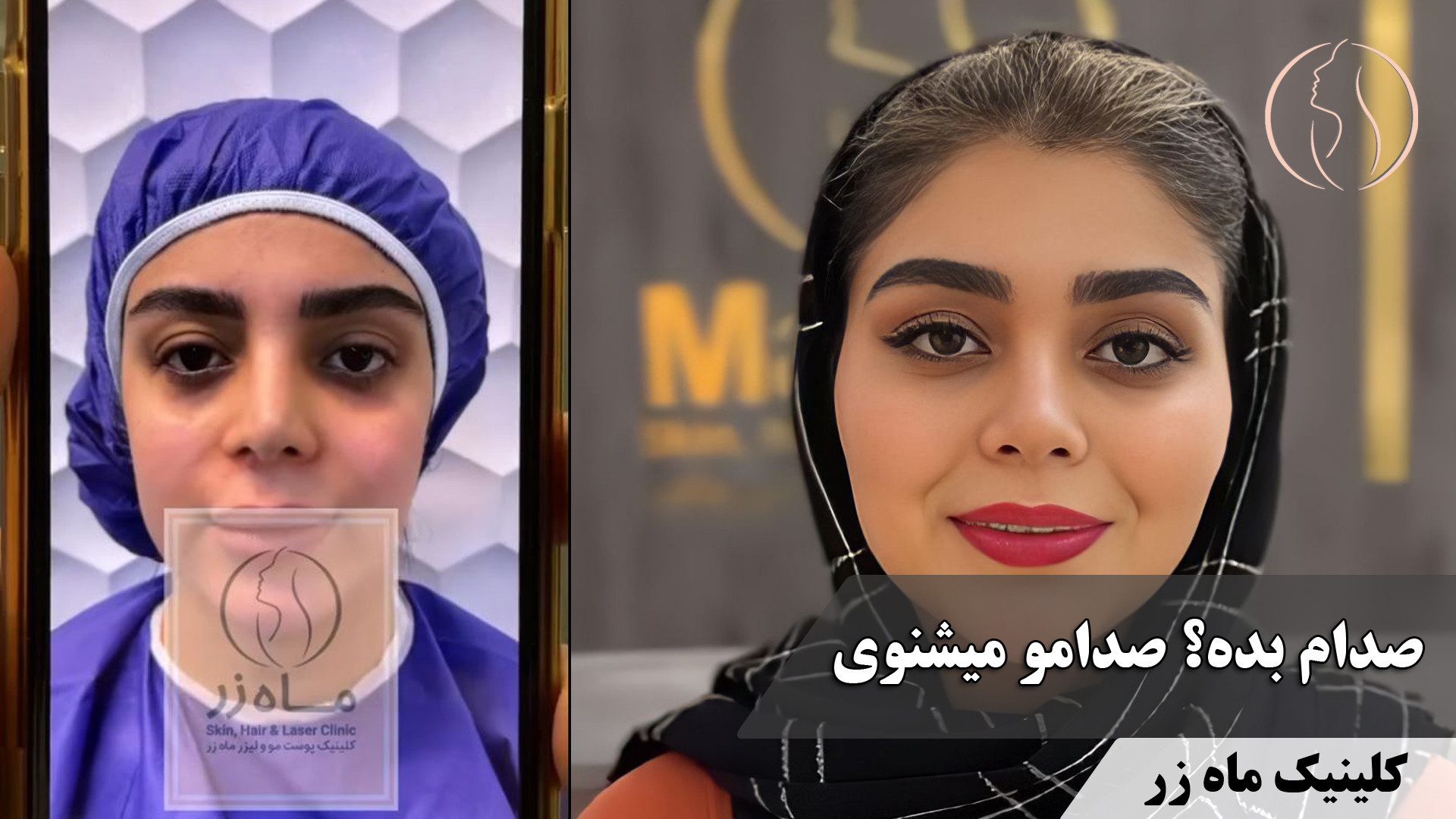 بازگشت به چهره بچه‌گونه ( کلینیک زیبایی ماه زر ) ارتودنسی