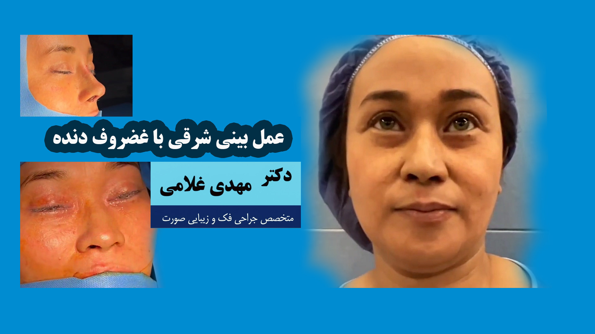 عمل بینی شرقی با غضروف دنده دکتر مهدی غلامی