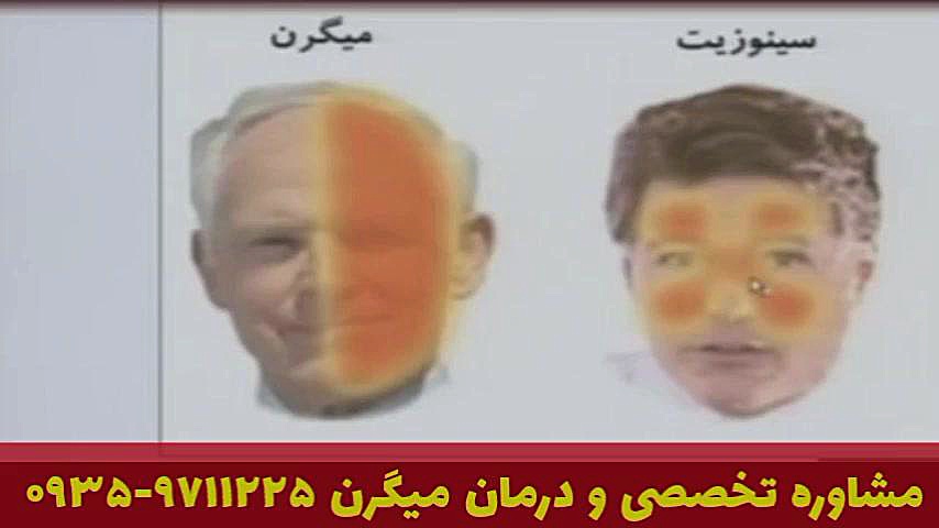 تفاوت سینوزیت و میگرن درمان قطعی میگرن ۰۹۳۵۹۷۱۱۲۲۵ هیو جکمن