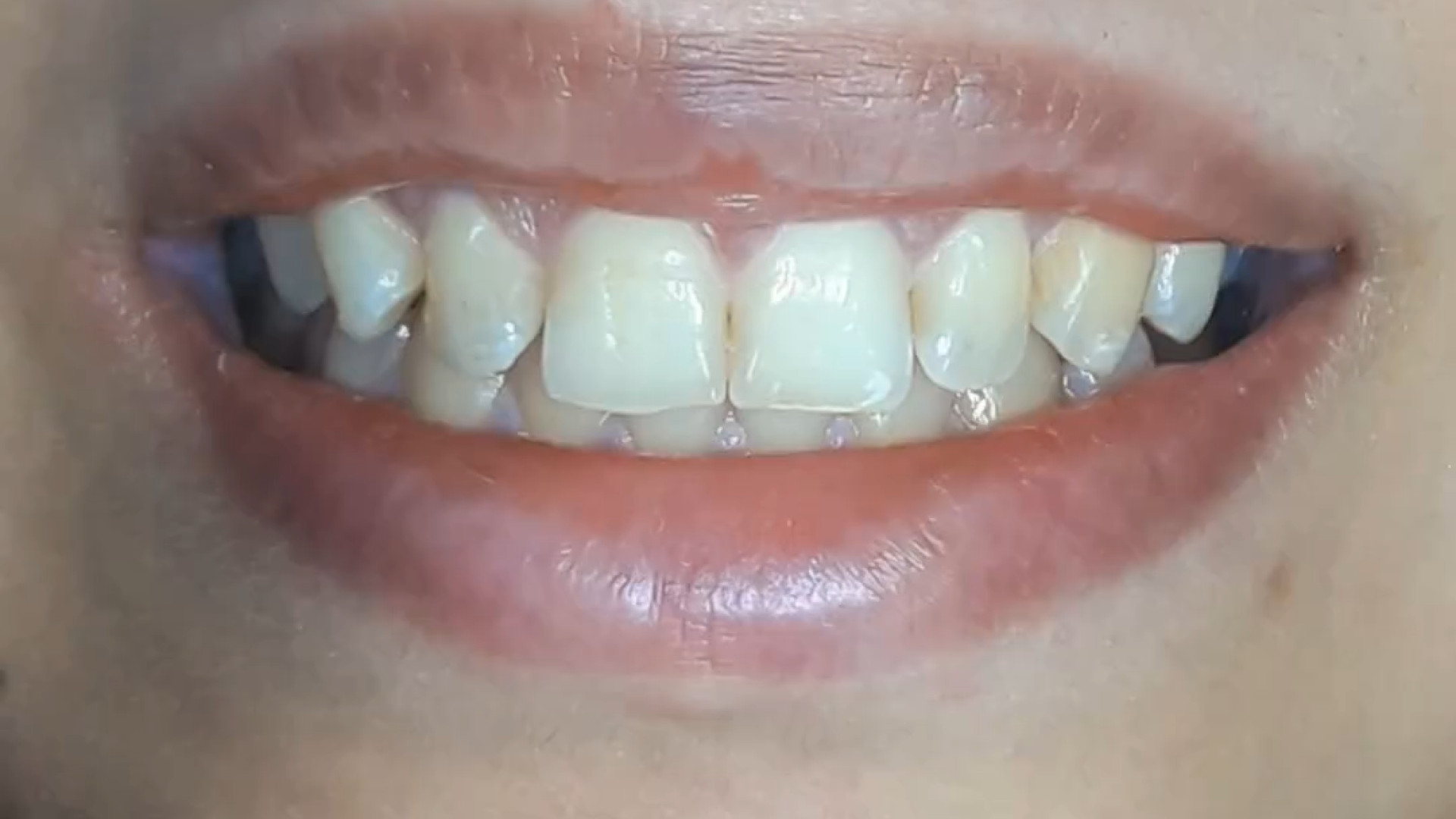 درمان لبخند لثه ای دکتر علی قمری - متخصص جراحی لثه و ایمپلنت