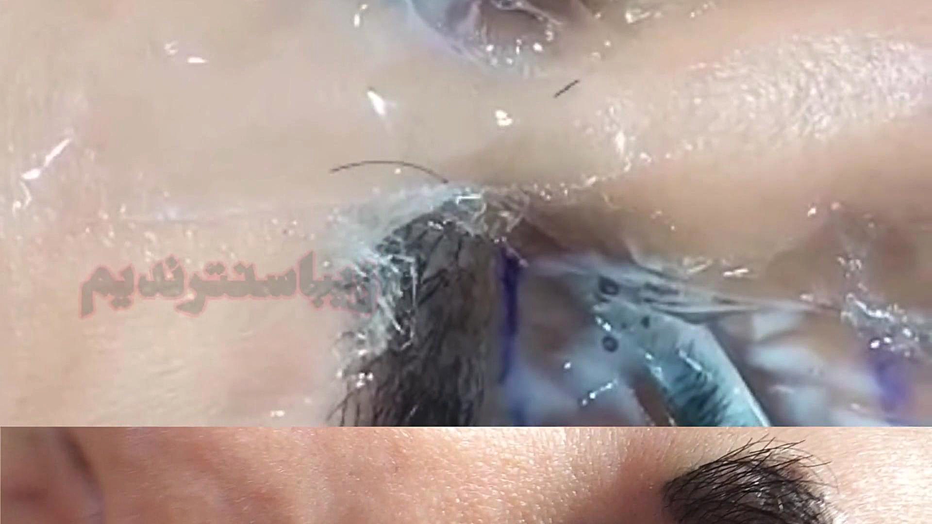 پلاسماجت پلک سندرم چیلبلینز