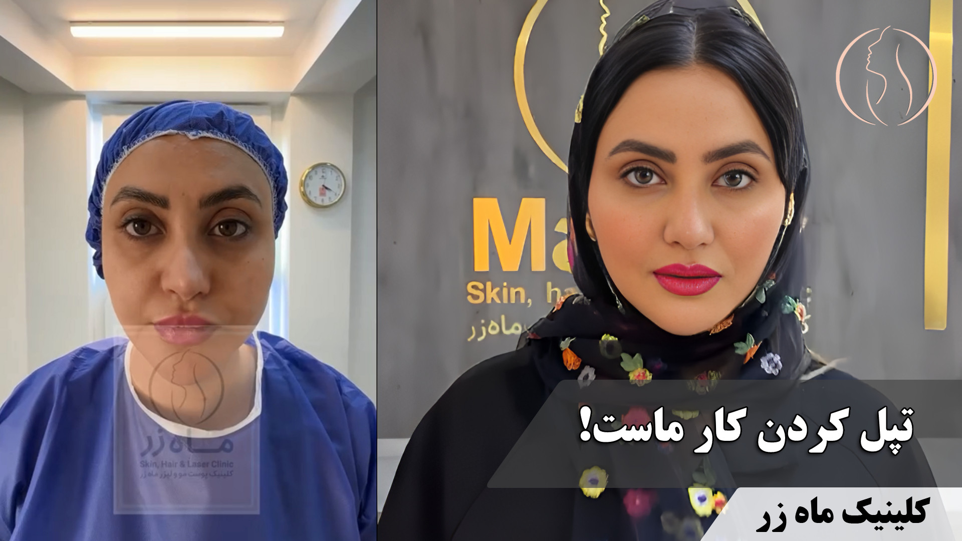 پشت پرده لپ‌های تپلی: کلینیک‌ها چه می‌کنند؟ ( کلینیک زیبایی ماه زر ) اونپاترو