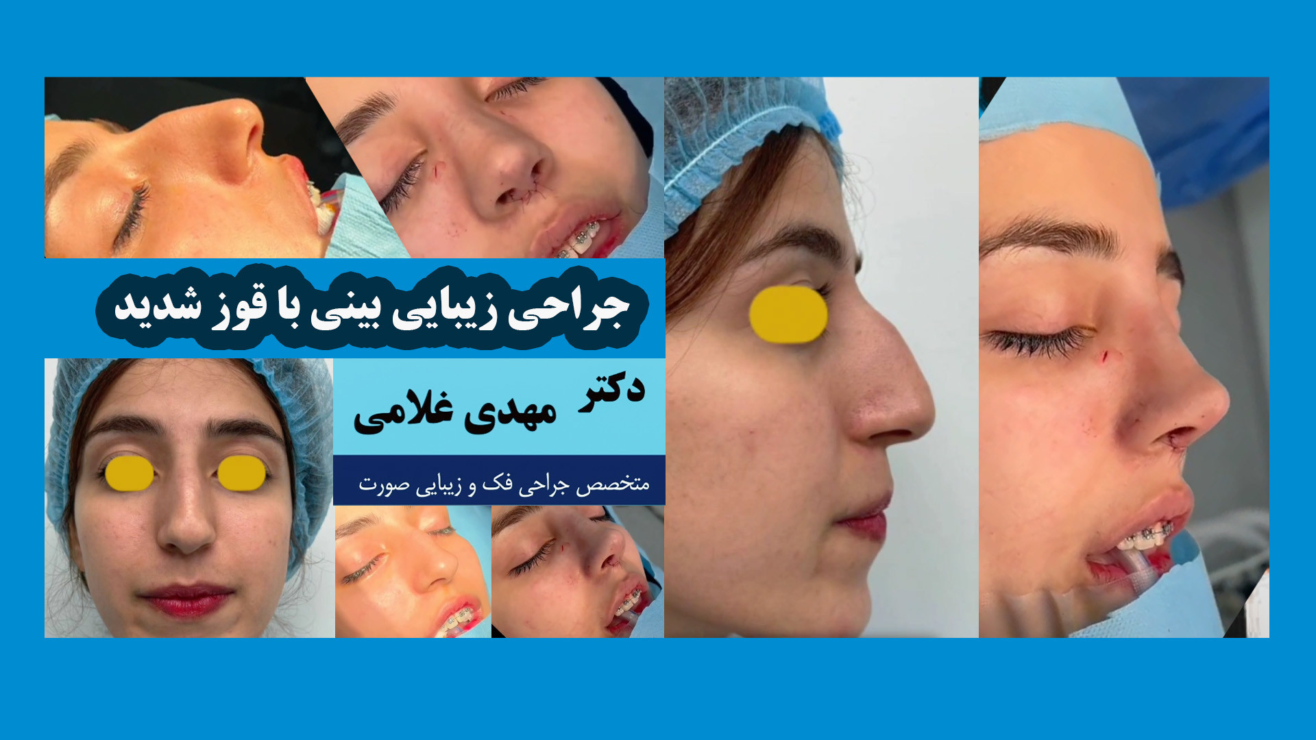 جراحی زیبایی بینی با قوز شدید دکتر مهدی غلامی