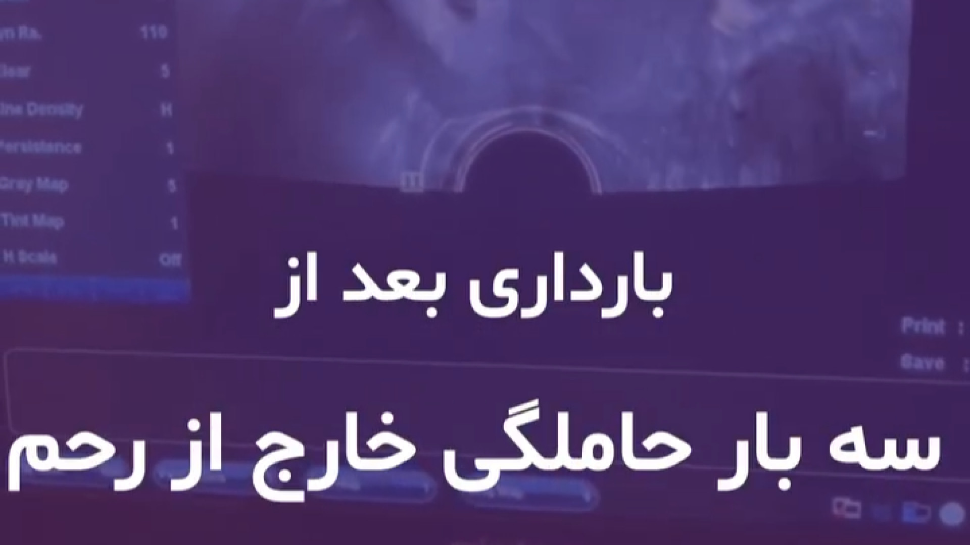 بارداری بعد از سه بار حاملگی خارج از رحم داریوش