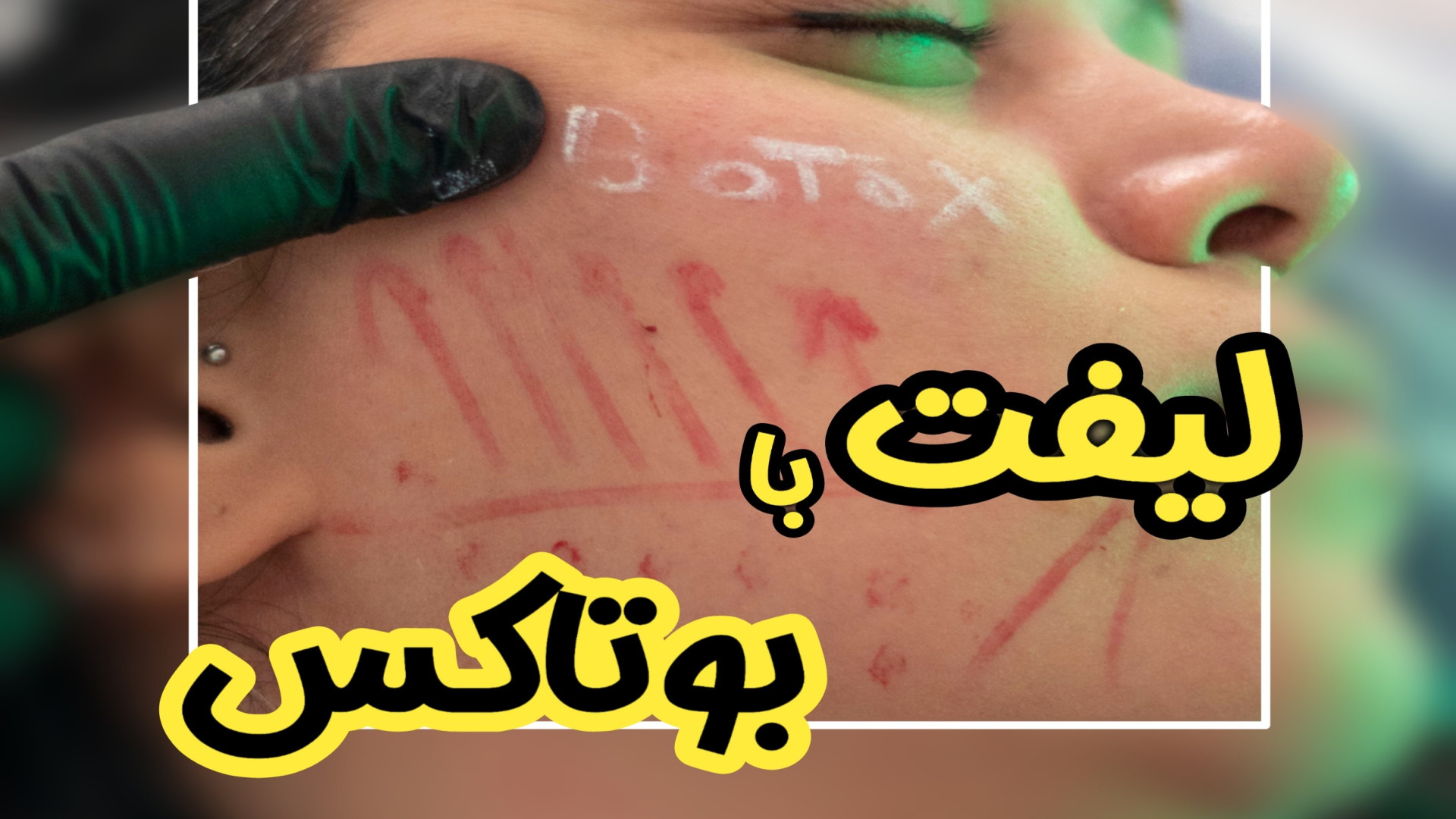 لیفت صورت با بوتاکس بررسی سطح اسید لاکتیک خون