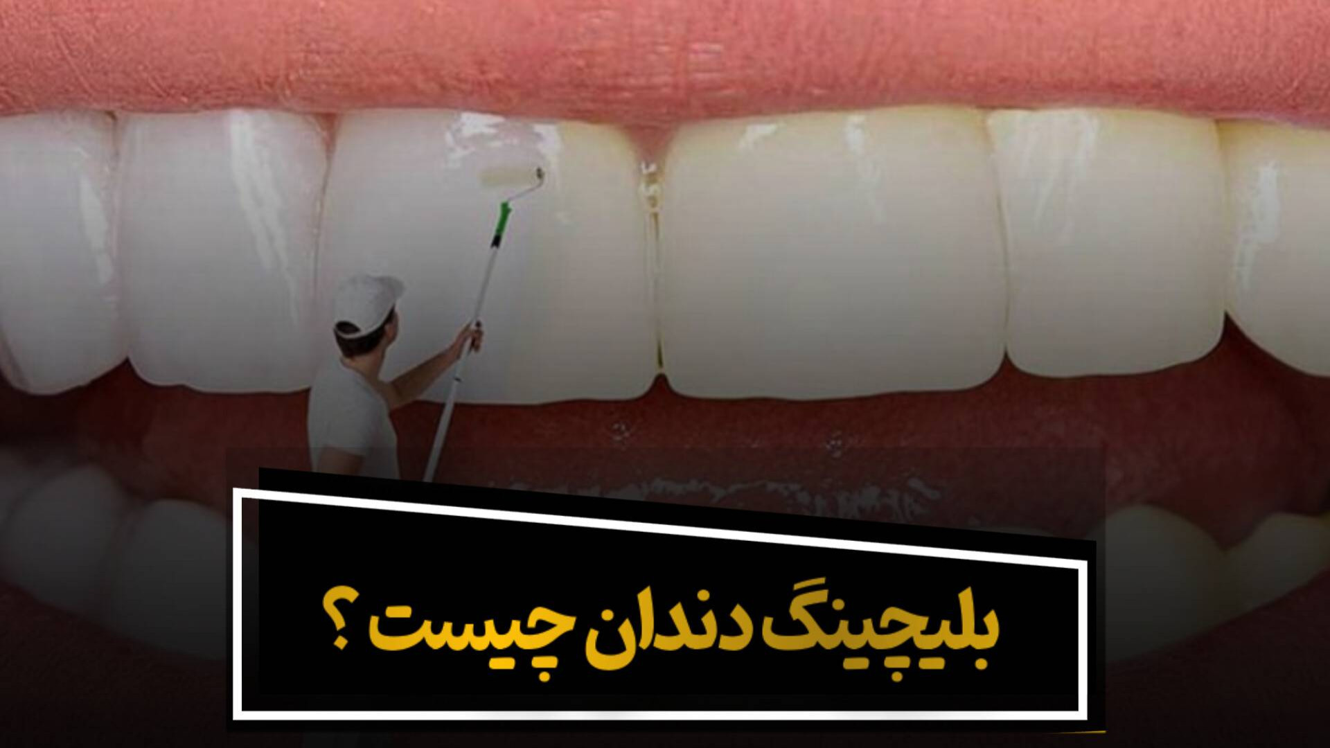 دندانپزشکی برلیان قرچک _بلیچینگ دندان Southern Blot