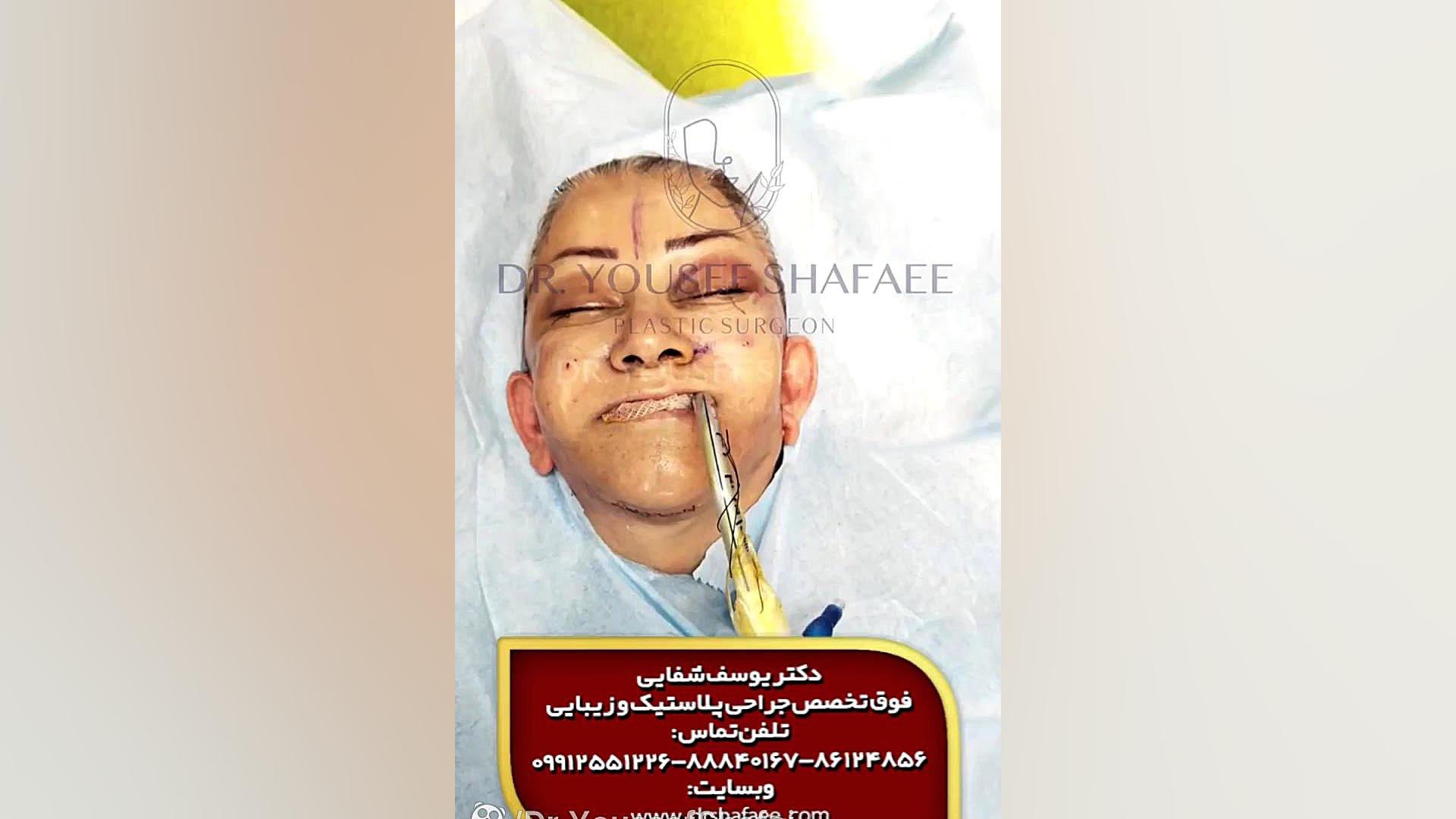 فیلم عمل جراحی پلاستیک توسط دکتر شفائی خانقاه دندان شیری