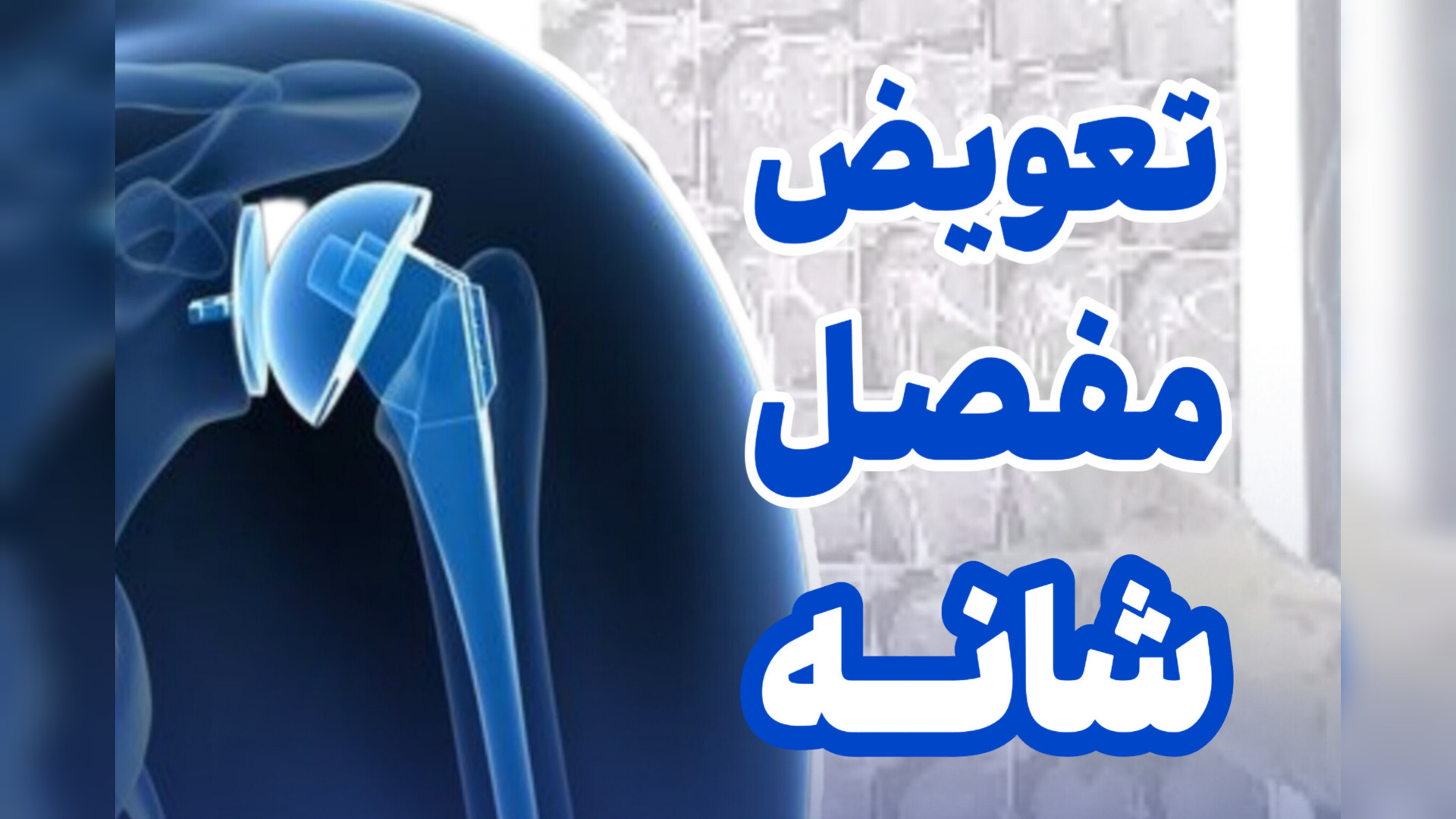 تعویض مفصل شانه دکتر محمود جعفر بیگلو