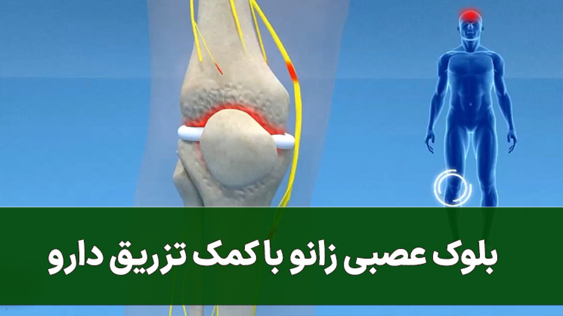 بلوک عصبی زانو لیفت صورت
