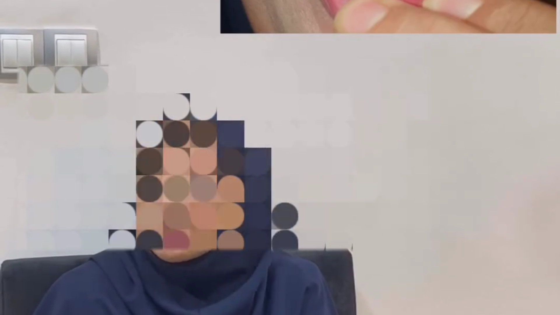 درمان ارتودنسی ثابت دو فک در مراجعه کننده ی ۴۷ ساله | دکتر ثریا یوسف نژاد دکتر ثریا یوسف نژاد متخصص ارتودنسی بابل