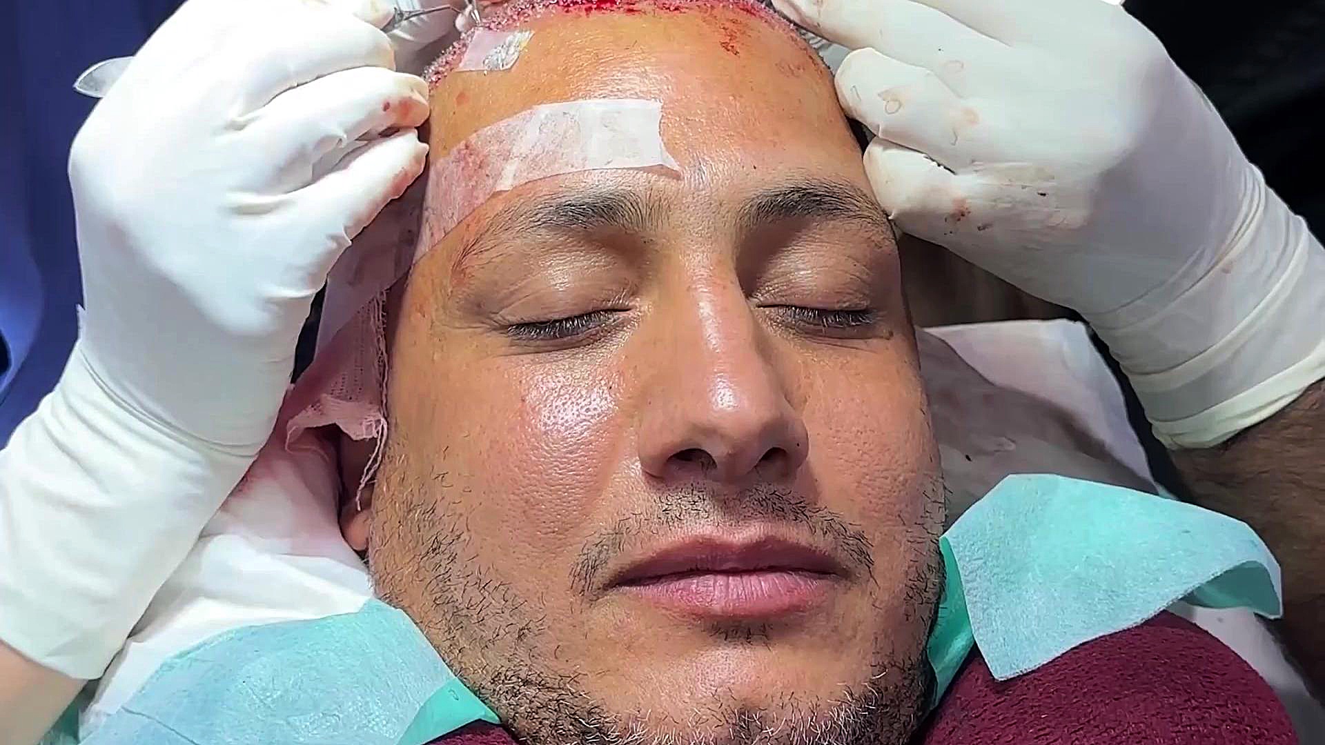 نمونه کار و رضایت زیباجویان کاشت مو کلینیک تندیس بیماری سندرم فریمن شلدون