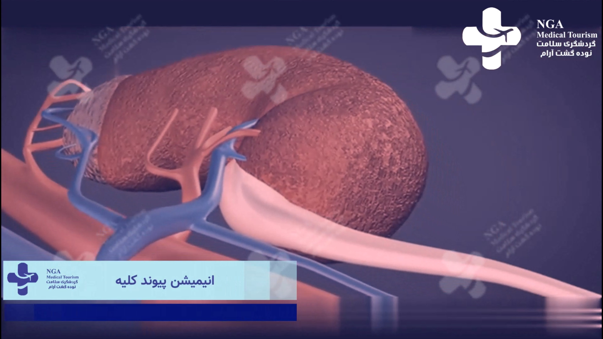 پیوند کلیه در ایران پریودنتیکس