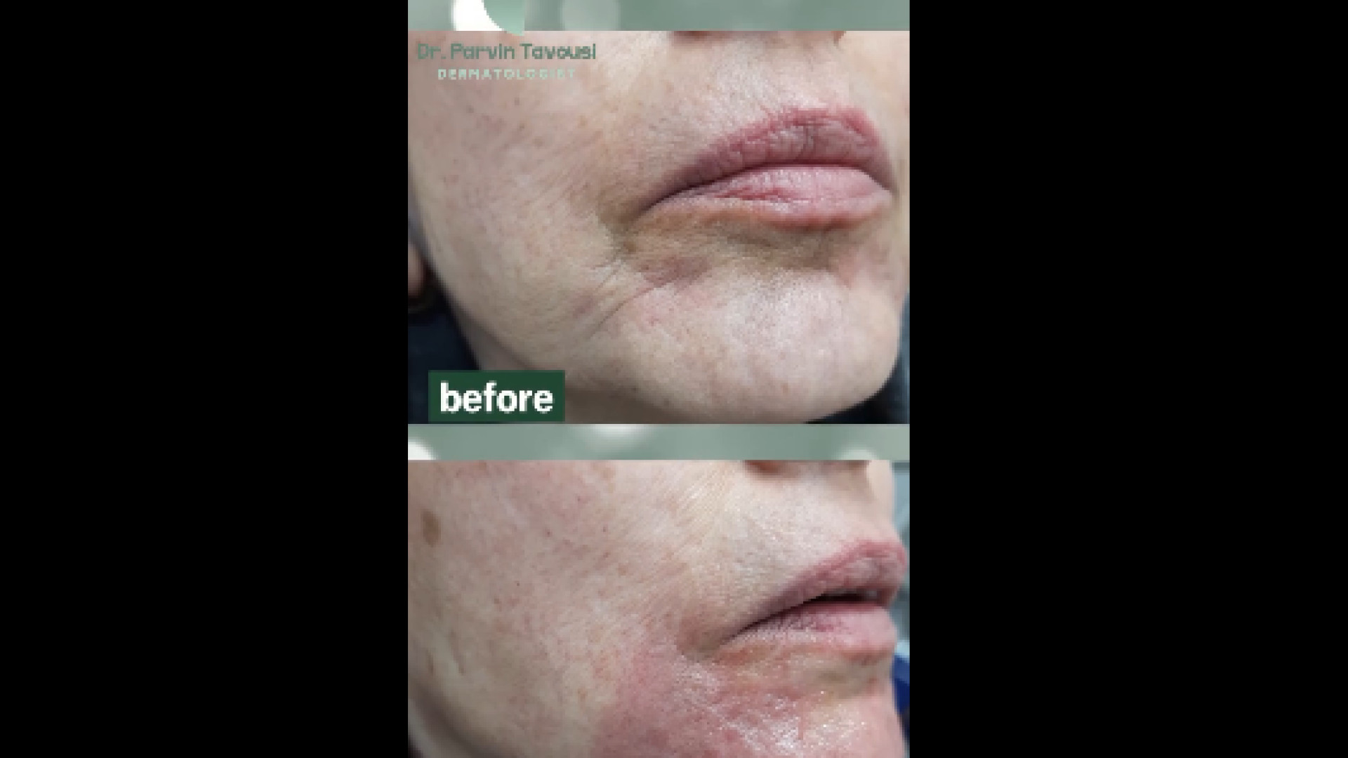 تزریق فیلر برای رفع چین و چروک دور لب دکتر پروین طاوسی - متخصص پوست، مو و زیبایی