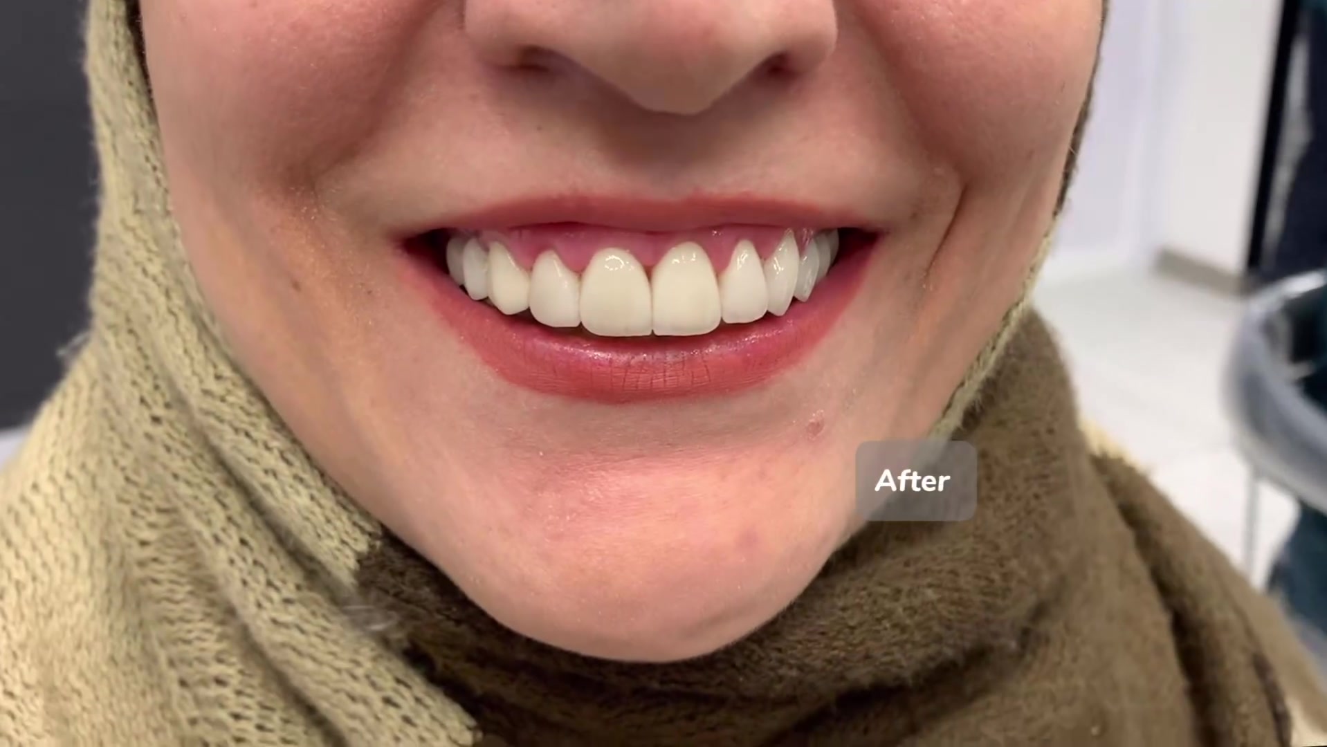 لمینت سرامیکی و اصلاح طرح لبخند در اصفهان | مرکز دندانپزشکی زیبایی دکتر عاطفت دکتر محمد عاطفت متخصص ترمیمی و زیبایی اصفهان