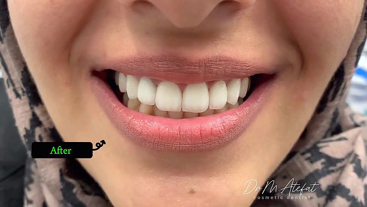لمینت سرامیکی دندان در اصفهان | دکتر محمد عاطفت متخصص دندانپزشکی زیبایی دکتر محمد عاطفت متخصص ترمیمی و زیبایی اصفهان