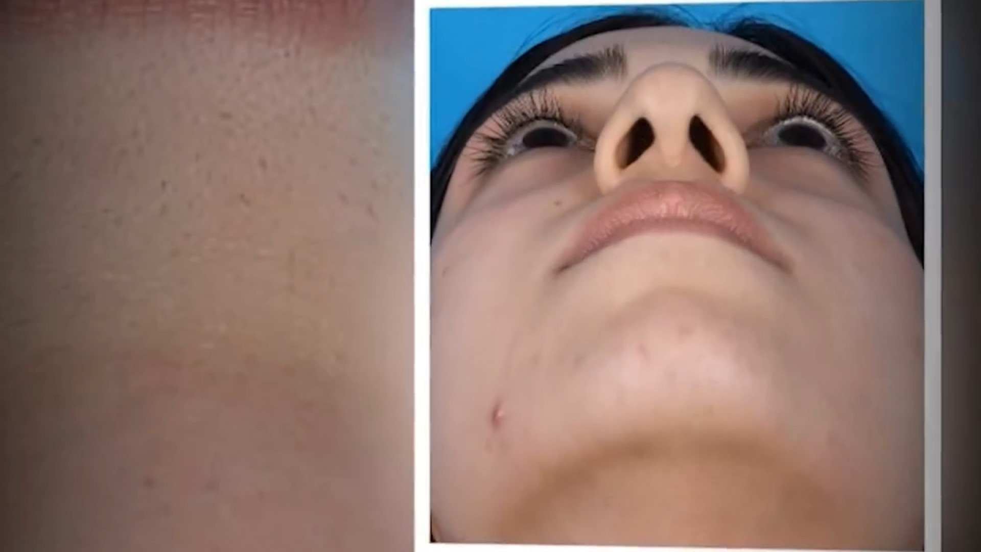 نتیجه عمل بینی دکتر علی جمشیدی