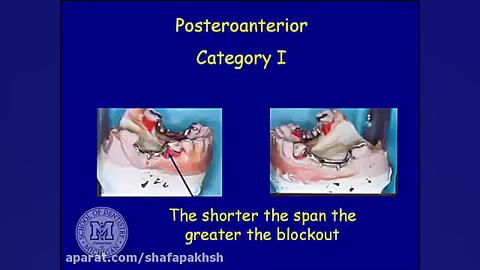 فیلم پروتز دندان Rotational path partial dentures عصب‌کشی