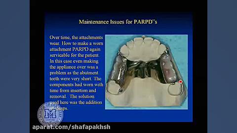 فیلم پروتز دندان Partial denture attachments بیماری ترومبوسایتوز اسنشیال