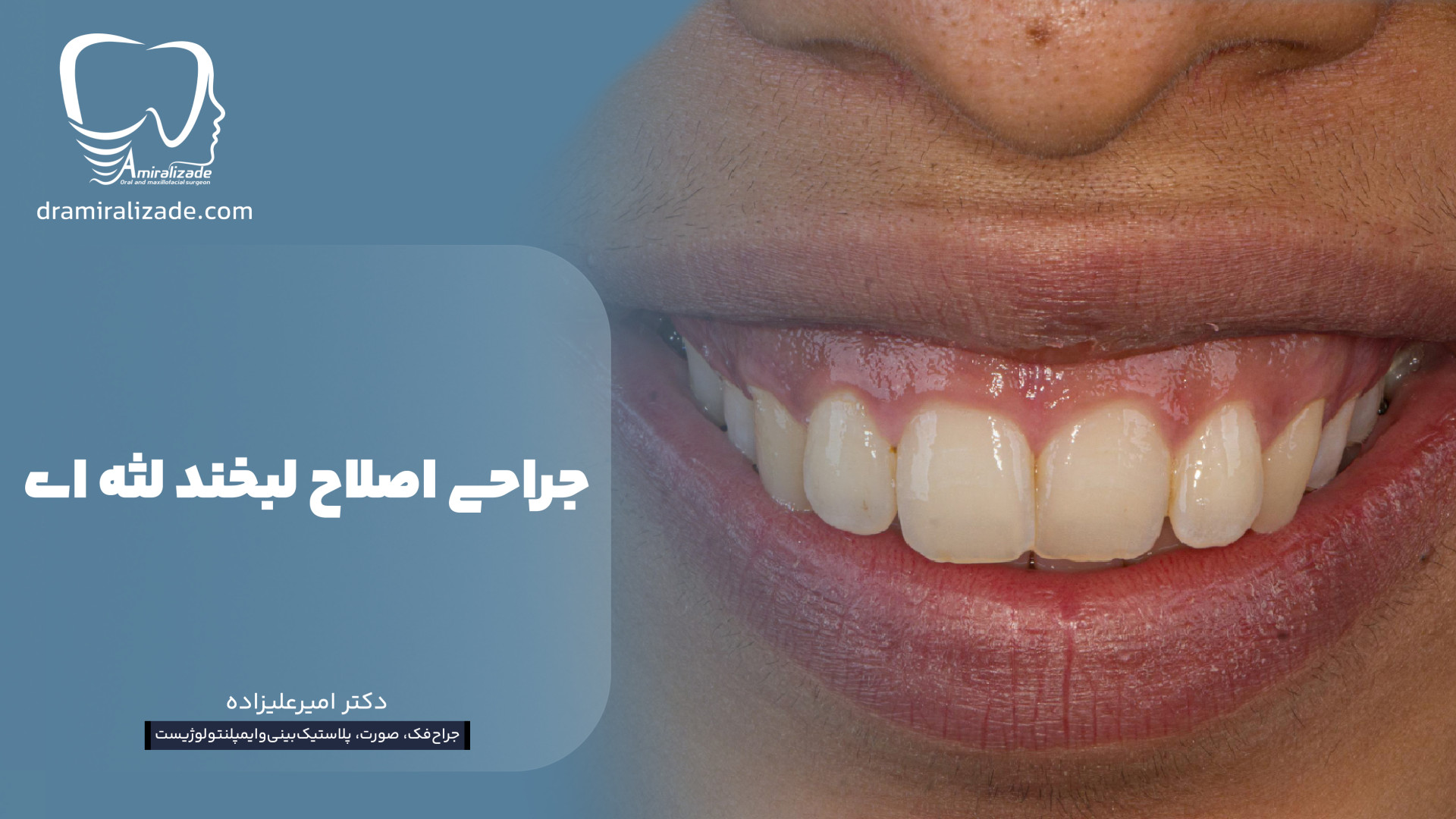 جراحی اصلاح #لبخند_لثه_ای سنداکتیلی