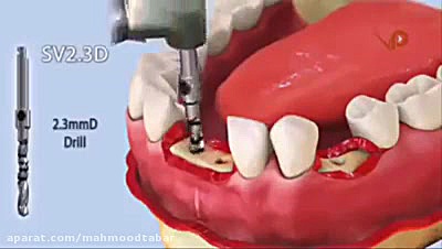 کاشت دندان ��اطلاعات پزشکی که هر شخصی باید بداند پزشکی کوهستان