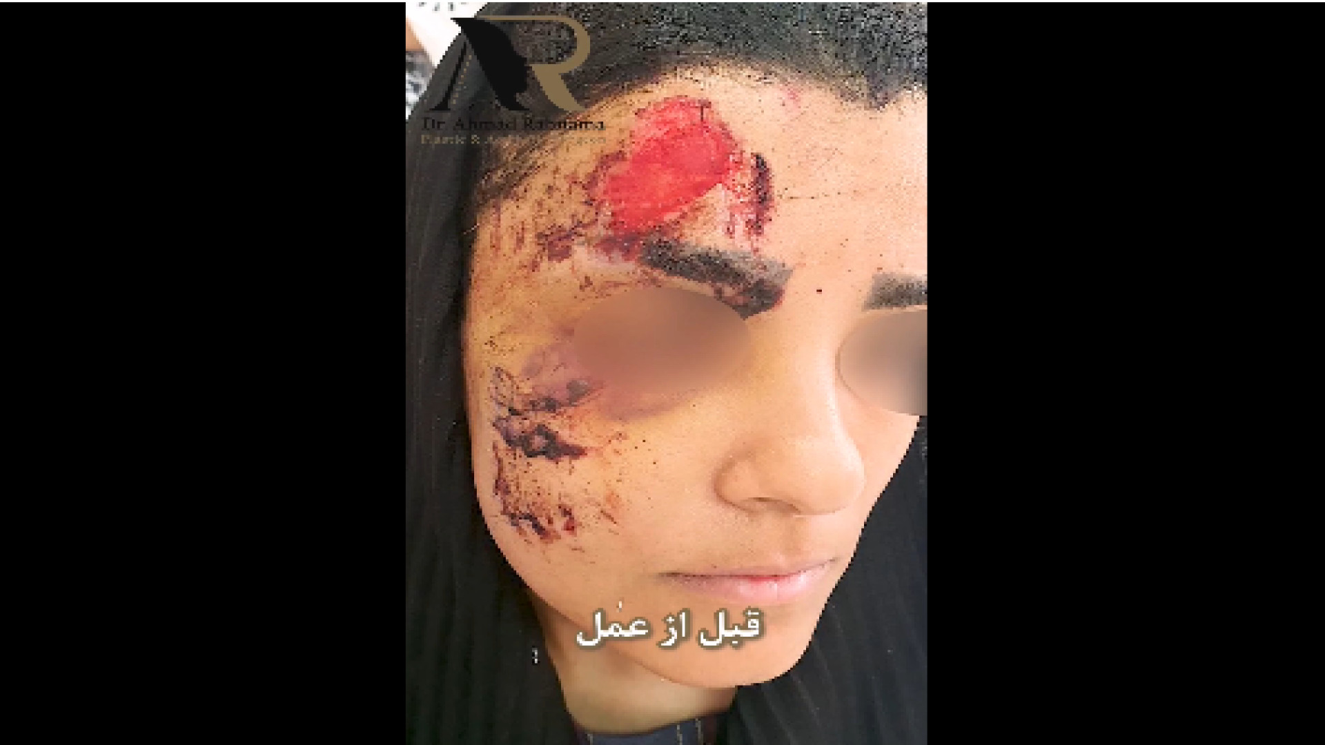 دو مرحله جراحی بعد از تروما برداشتن توده