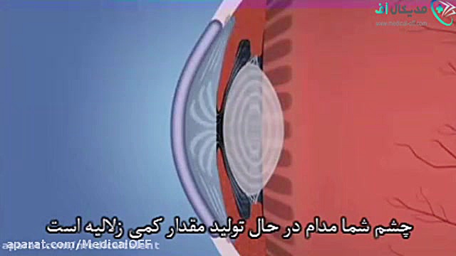 آب سیاه(گلوکوم) عصب‌کشی
