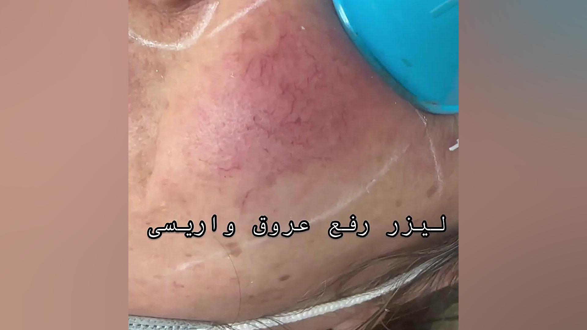 رفع قرمزی صورت و عروق واریسی با استفاده از لیزر دکتر فرحناز زینعلی - متخصص پوست، مو، زیبایی زنجان