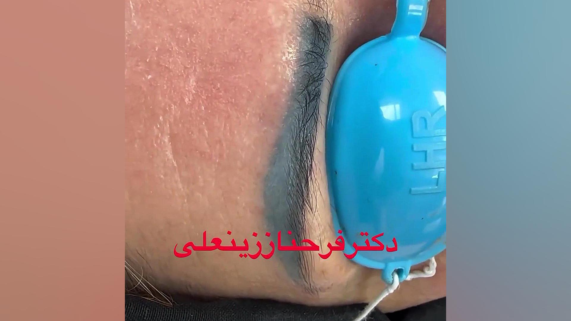 رفع تتو و هاشور فقط با لیزر کیوسویچ دکتر فرحناز زینعلی - متخصص پوست، مو، زیبایی زنجان
