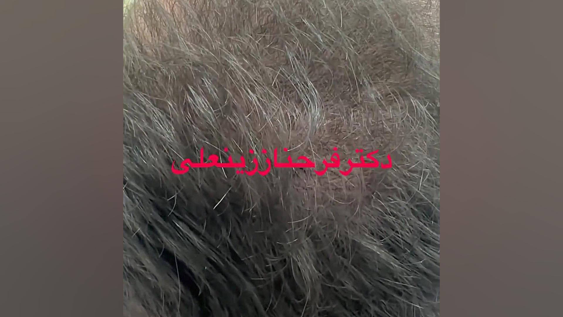 قطع ریزش مو با دارو وتزریق مزو پی ارپی دکتر فرحناز زینعلی - متخصص پوست، مو، زیبایی زنجان
