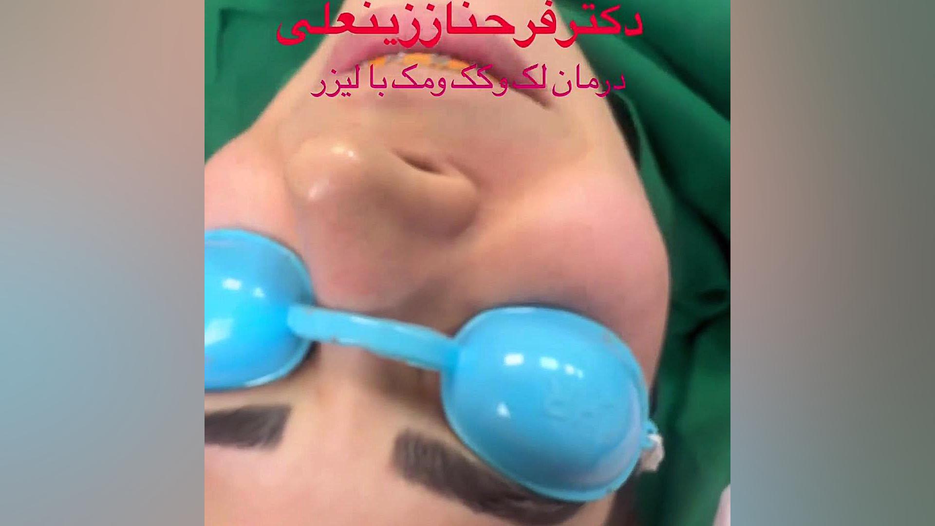 نتیجه بعد از جلسه اول برای درمان لک و کک و مک با لیزرهای پیشرفته دکتر فرحناز زینعلی - متخصص پوست، مو، زیبایی زنجان