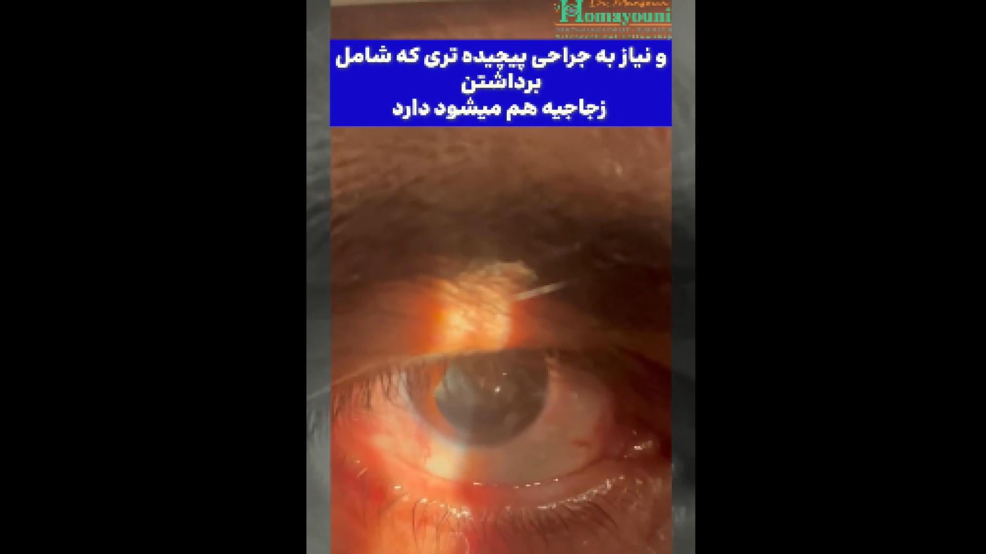 آب مروارید و در رفتگی لنز به علت ضربه به چشم زاویه سازی صورت