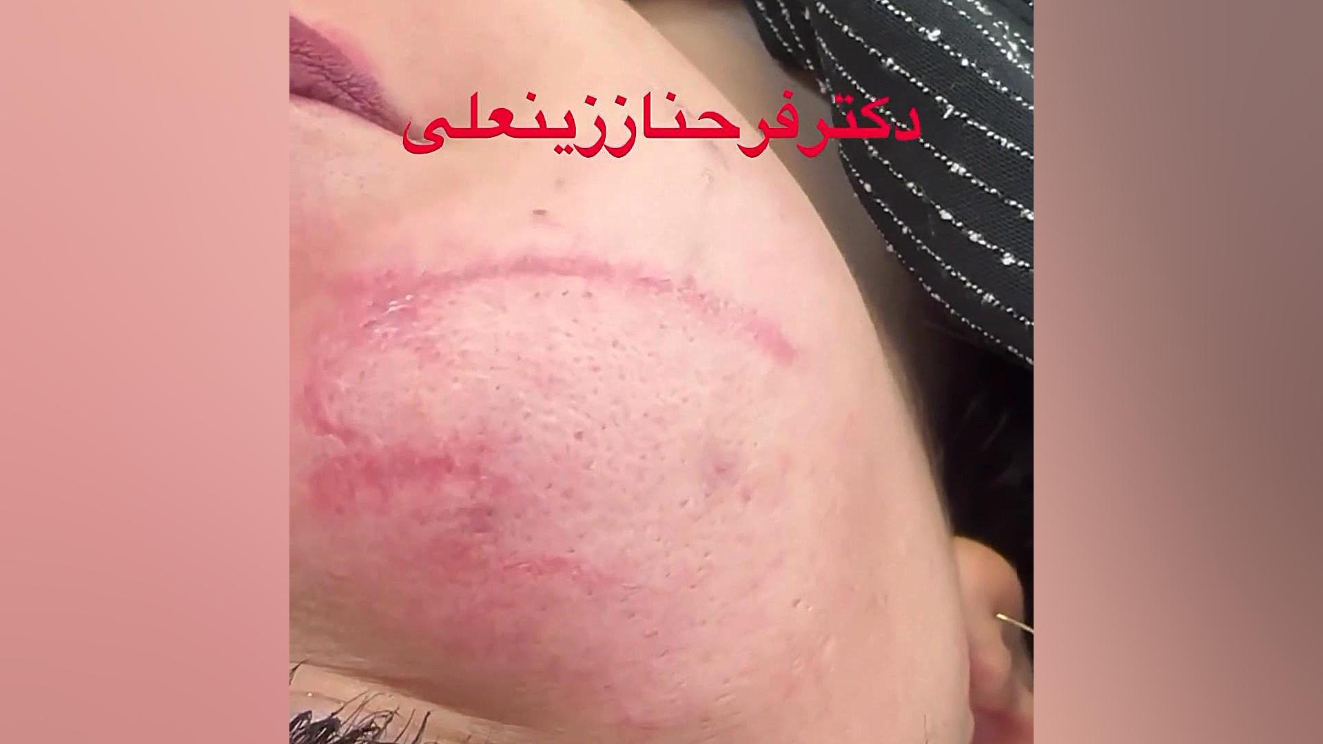 نتیجه عالی یک جلسه لیزر جای بریدگی و بخیه روی صورت دکتر فرحناز زینعلی - متخصص پوست، مو، زیبایی زنجان