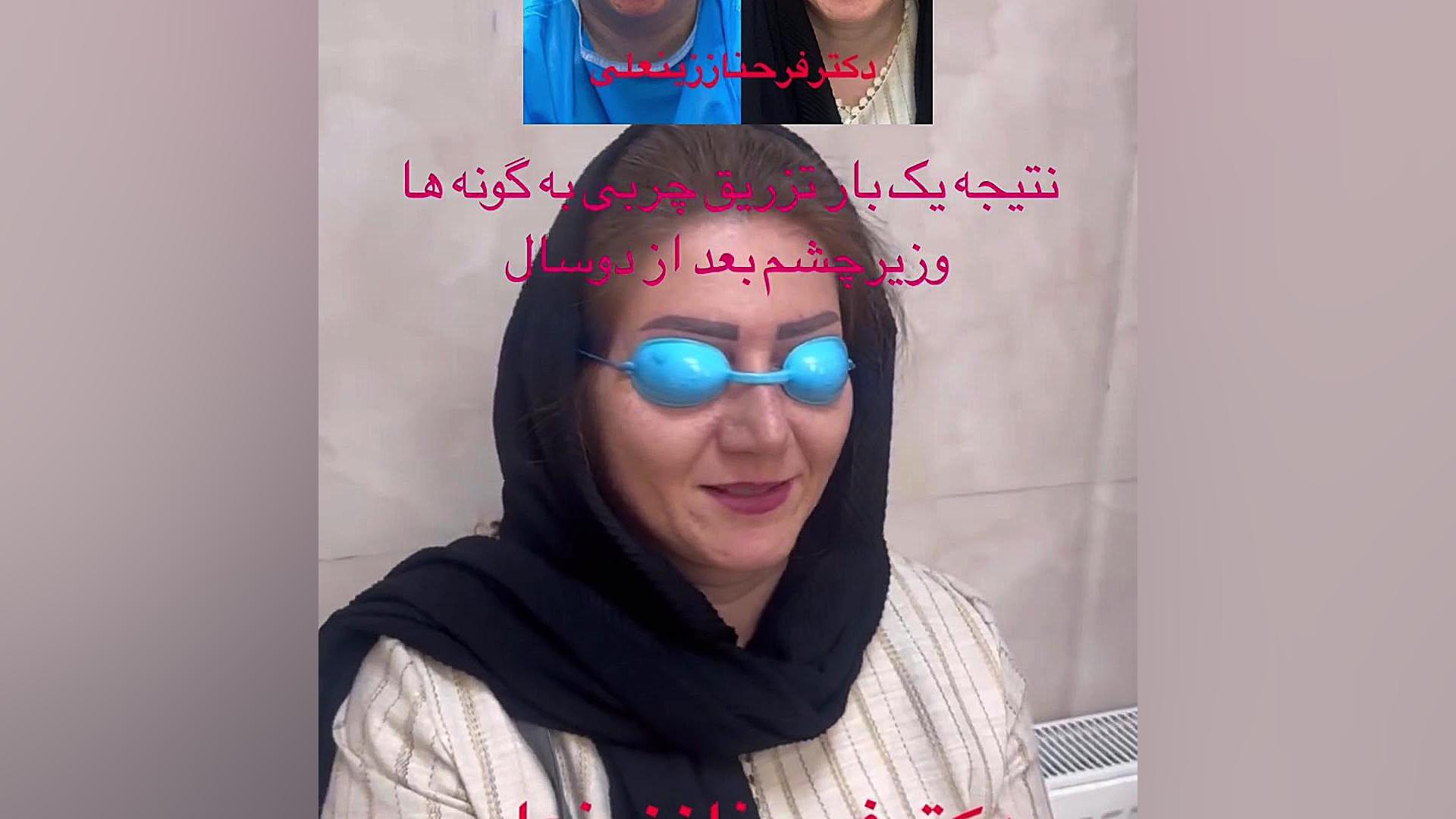 نتیجه تزریق چربی به گونه ها و زیر چشم بعد از دو سال دکتر فرحناز زینعلی - متخصص پوست، مو، زیبایی زنجان