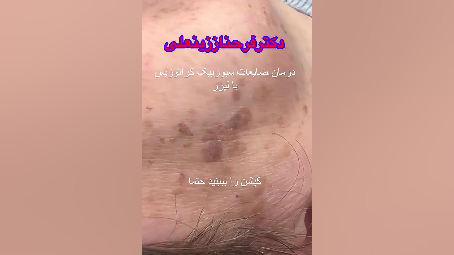 نتیجه لیزر ضایعات صورت دکتر فرحناز زینعلی - متخصص پوست، مو، زیبایی زنجان