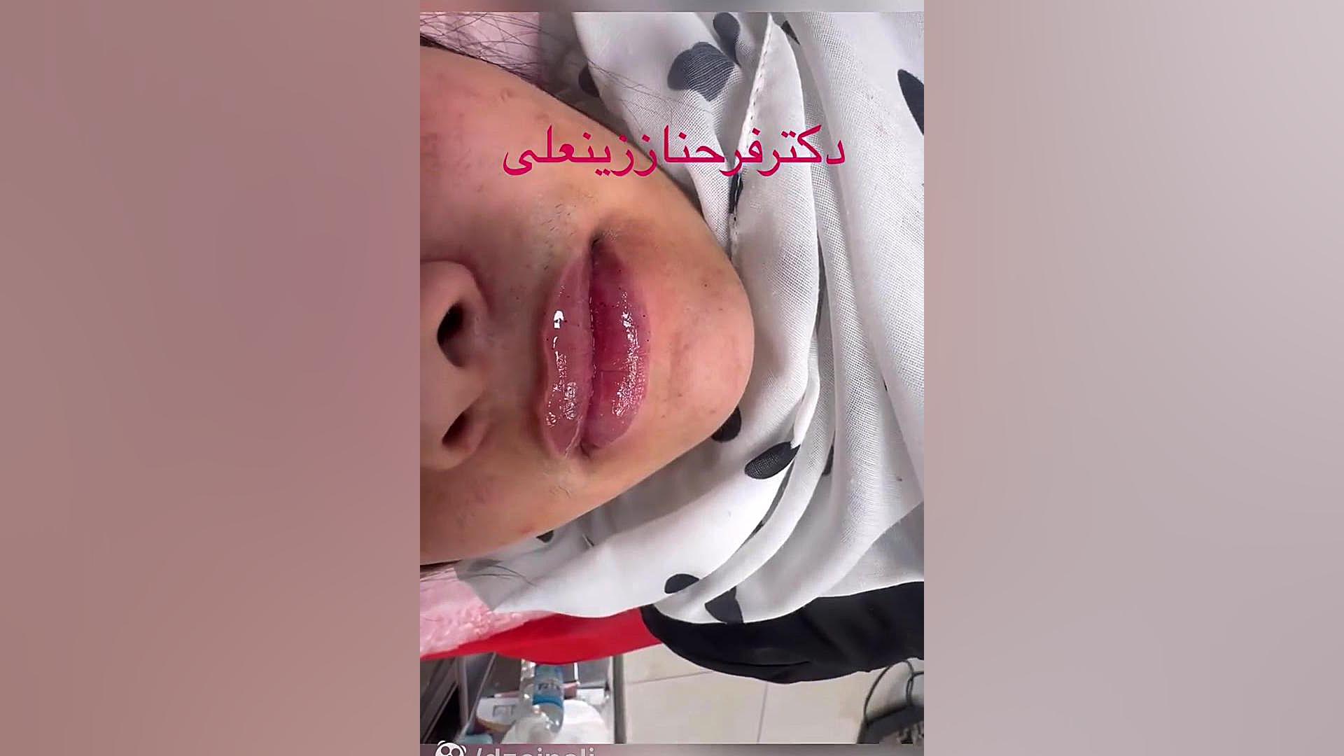 تزریق کمتر از بک سی سی فیلر لب هیالورونیک اسید مارک دار به متد روسی دکتر فرحناز زینعلی - متخصص پوست، مو، زیبایی زنجان