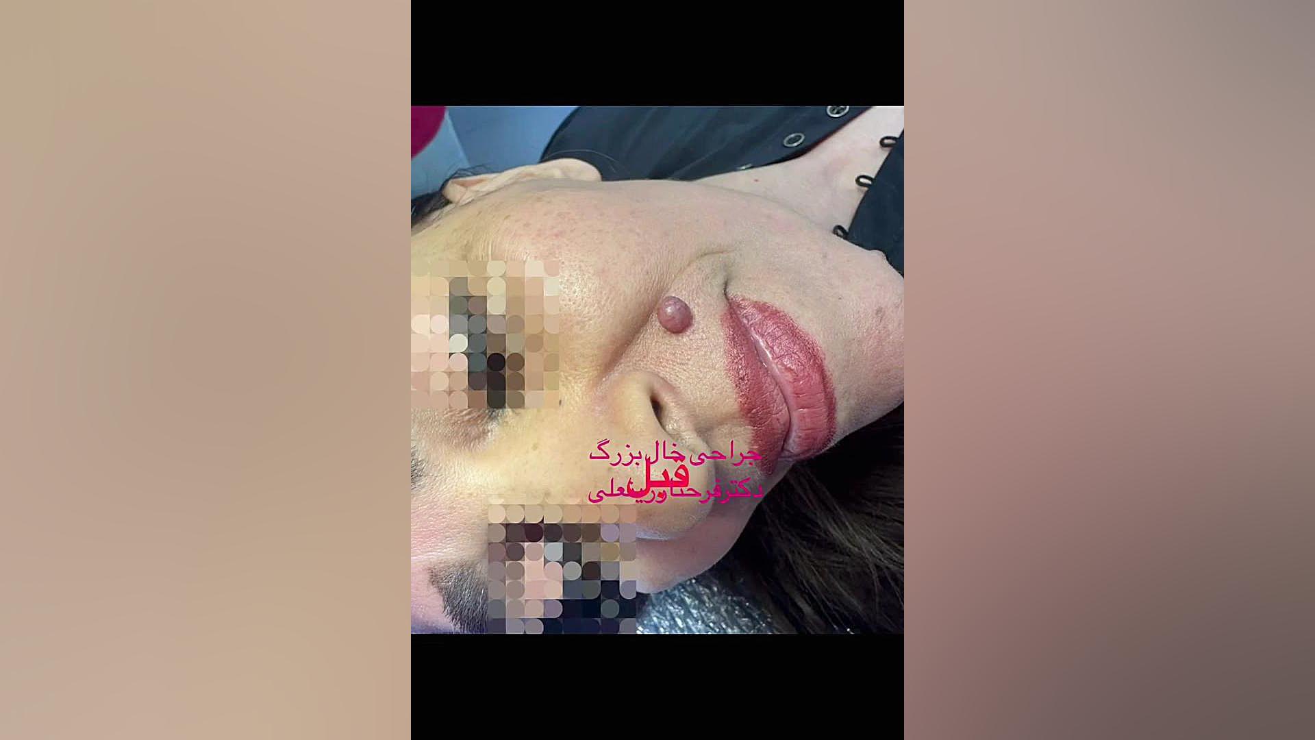 جراحی خال یزرگ عکس قبل و بعد از جراحی دکتر فرحناز زینعلی - متخصص پوست، مو، زیبایی زنجان