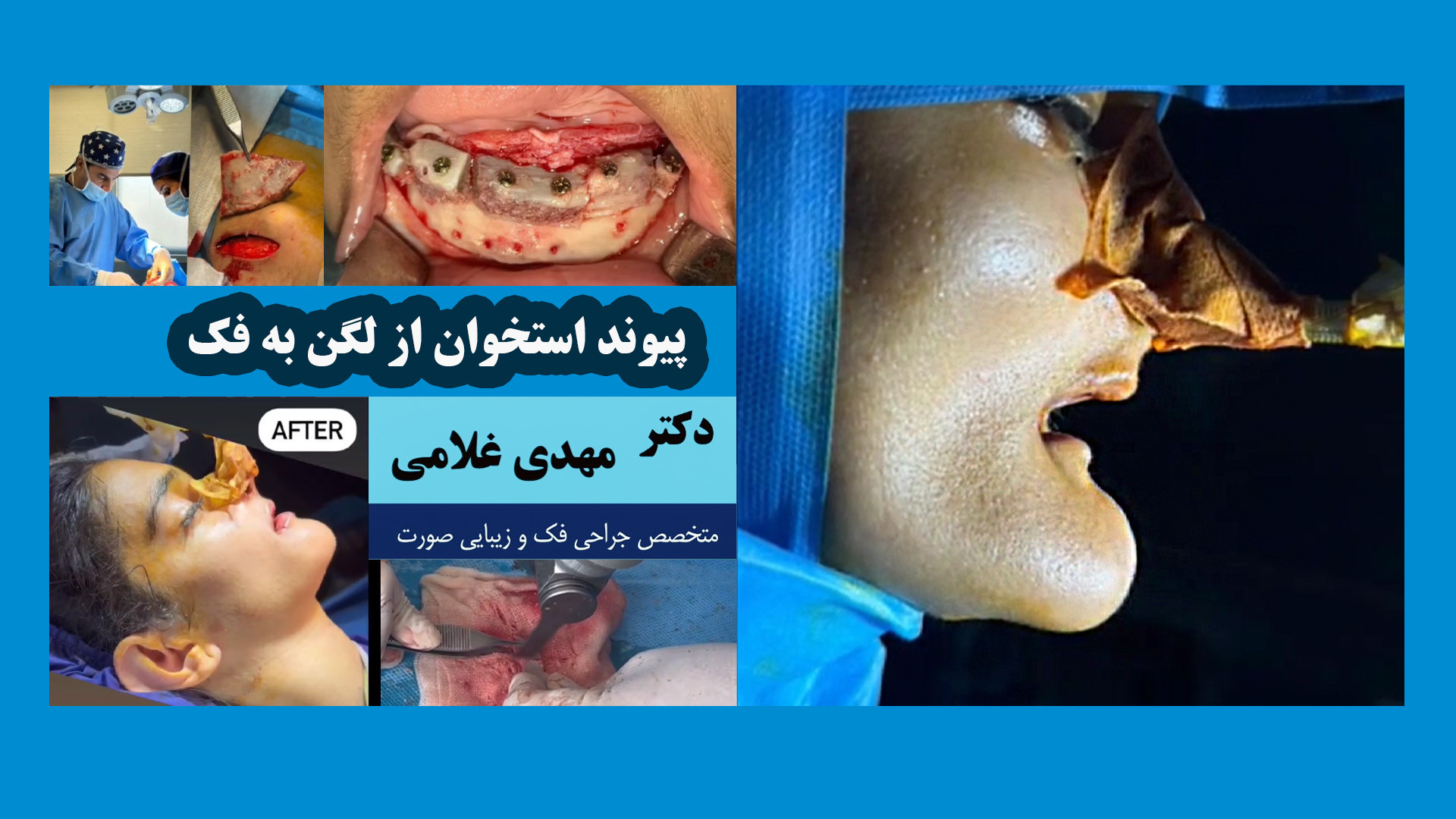 پیوند استخوان از لگن به فک با دکتر مهدی غلامی دکتر مهدی غلامی