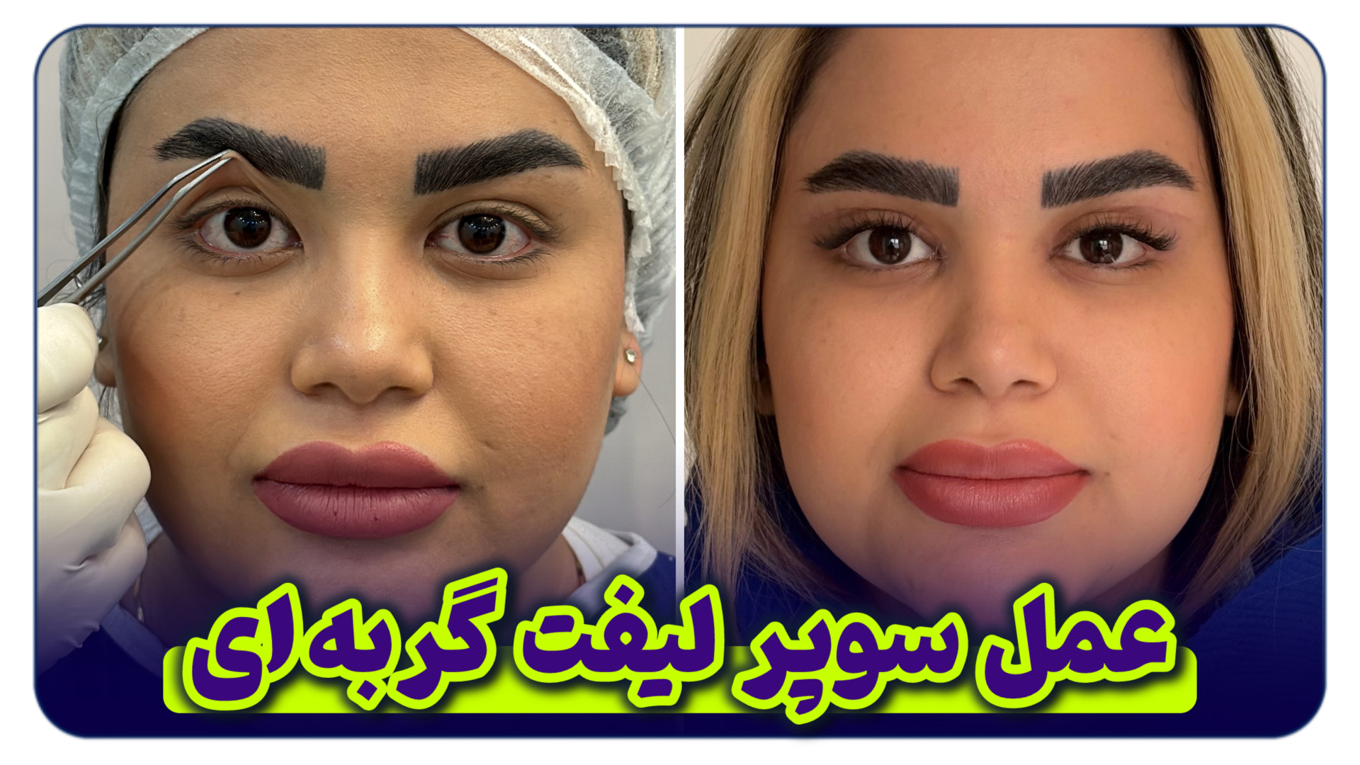 بلفاروپلاستی چشم گربه ای با بخیه لیزری در بلفالوکس جنیفر لارنس
