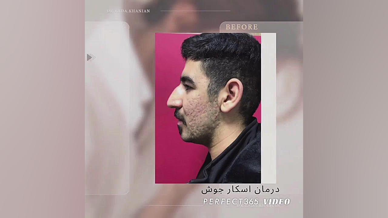 درمان قطعی اسکار جای جوش با روش ترکیبی سابسیژن و کربوکسی تراپی تالاسمی دلتا-بتا