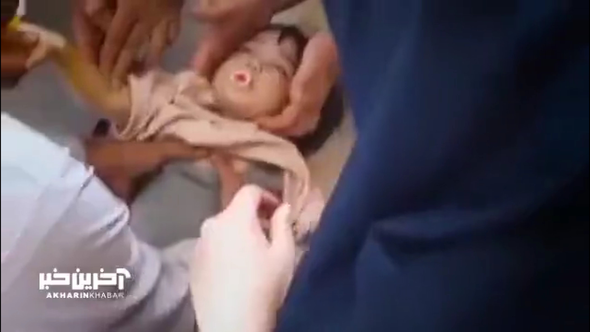 لحظه نجات شیرین کودک توسط نیروهای اورژانس اصفهان لیفت صورت
