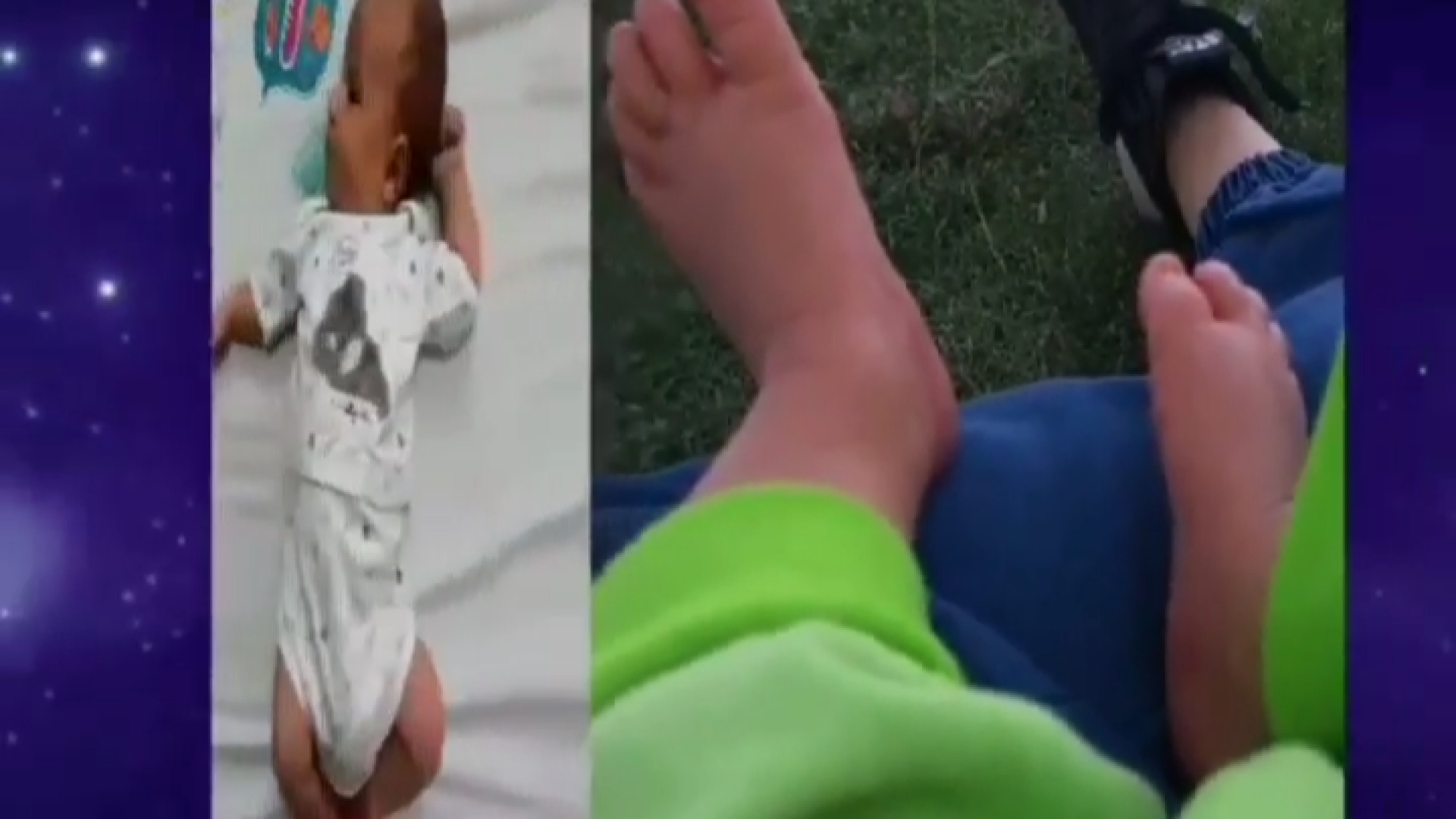 بارداری - دکتر نگین حدادی میکرونیدلینگ