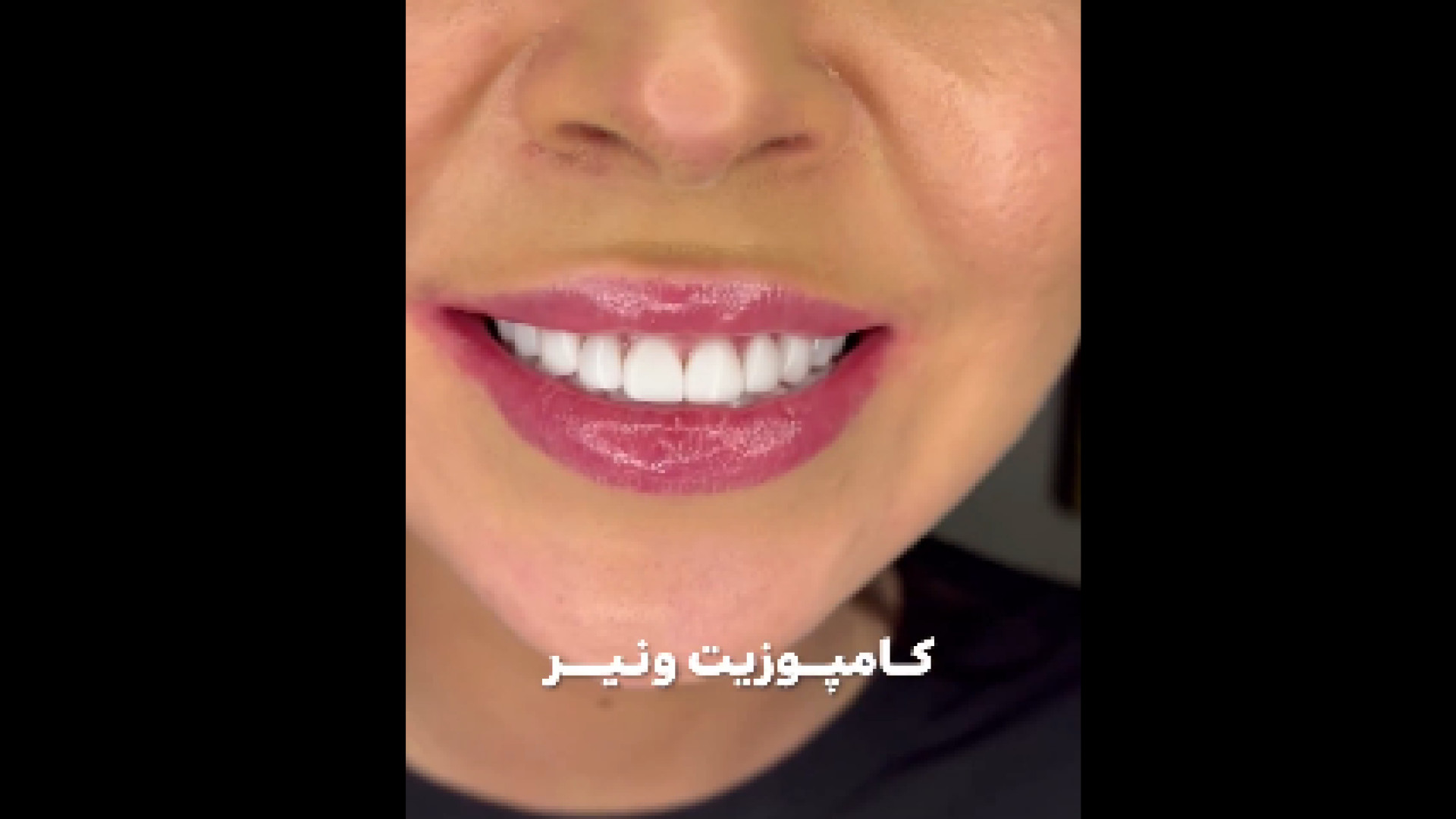 نمونه کامپوزیت ونیر بیومهندسی عصبی