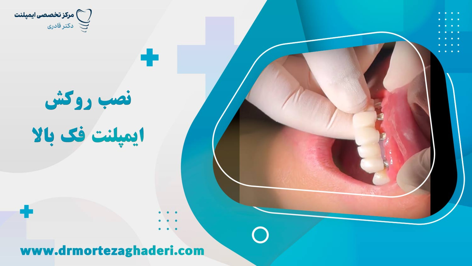 نصب روکش ایمپلنت فک بالا پزشکی تله‌مدیسین تخصصی