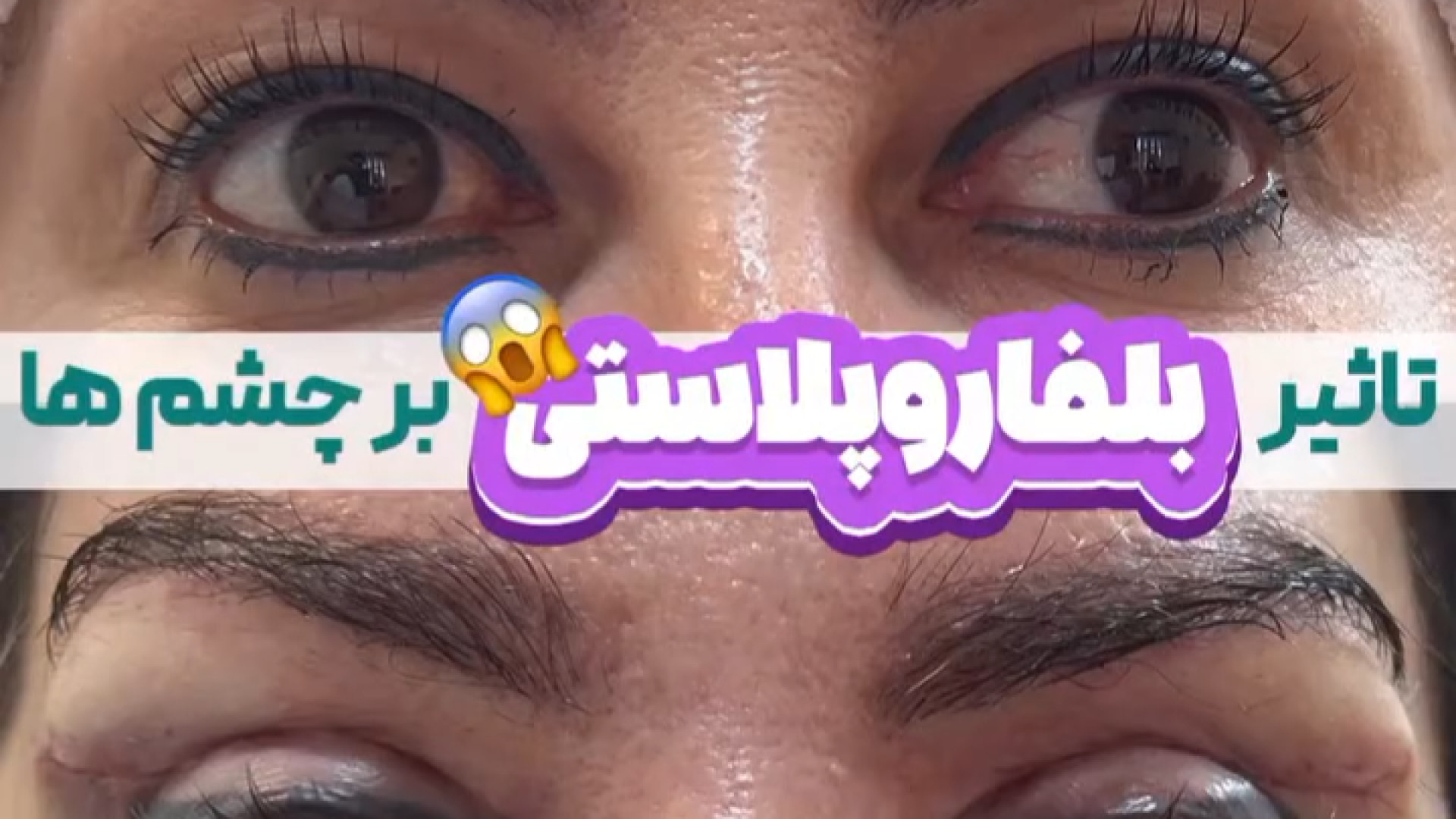 نتایج باورنکردنی از عمل بلفاروپلاستی دکتر خشایار سنجری متخصص جراحی جنرال و زیبایی